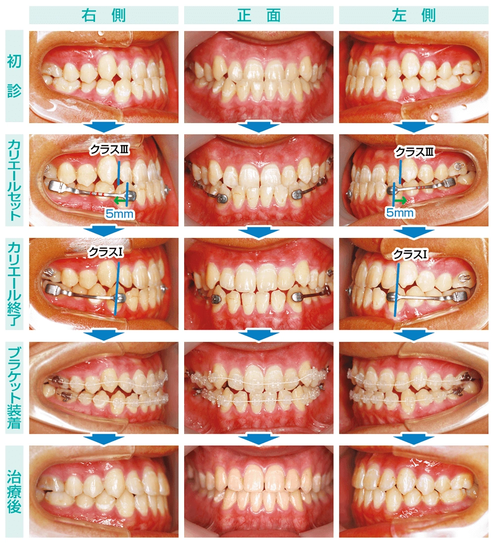 Vol.186 上顎前突に対する段階的アプローチ：非抜歯から抜歯治療へ